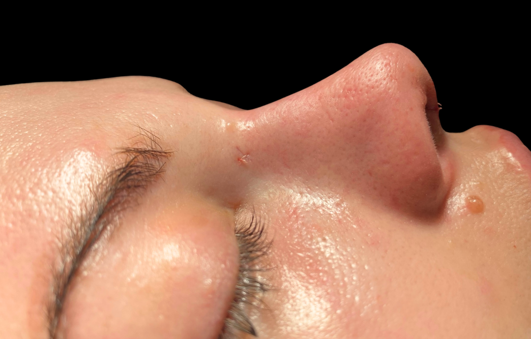 antalya burun estetiği fiyatları