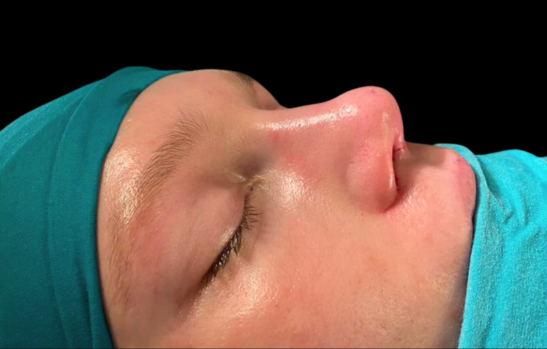 antalya rinoplasti , rinoplasti ameliyatı antalya ,rinoplasti burun estetiği , revizyon burun estetiği , revizyon burun estetiği fiyatları , revizyon burun estetiği antalya